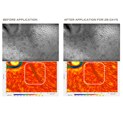 21.84%* decrease in wrinkle area in nasolabial fold