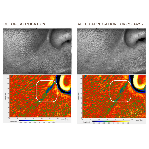 19.77%* decrease in wrinkle volume in nasolabial fold